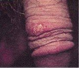 Herpes genitalis - Генитални херпес је полна болест са типичним симптомима на слици