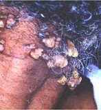 На слици је хиперпластични (џиновски) molluscum contagiosum, на предњој страни врата, као симптом ове полно преносиве болести код 40-о-годишњег пацијента који има болест СИДУ