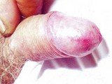 Полне болести слика 1 - Симптоми Balanitis et balanoposthitis код мушкараца који су често узроковани кандидом која може бити и полна болест