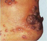 На слици је Капошијев сарком (Kaposi sarcoma) као један од најчешћих тумора односно симптома полне болести СИДЕ