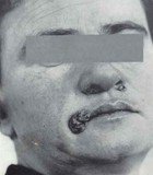 Слика приказује јако проминентне тзв. луксурирајуће папуле које су симптом секундарног сифилиса као облика ове полне болести