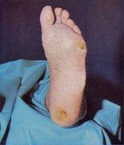 Malum perforans код tabes dorsalis је још један начин како се испољава ова полна болест