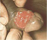 На слици је примарни шанкр као симптом полне болести сифилиса