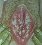 На слици се виде симптоми трихомонијазе као полно преносиве инфекције чије симптоме код жена узрокује паразит трихомонас